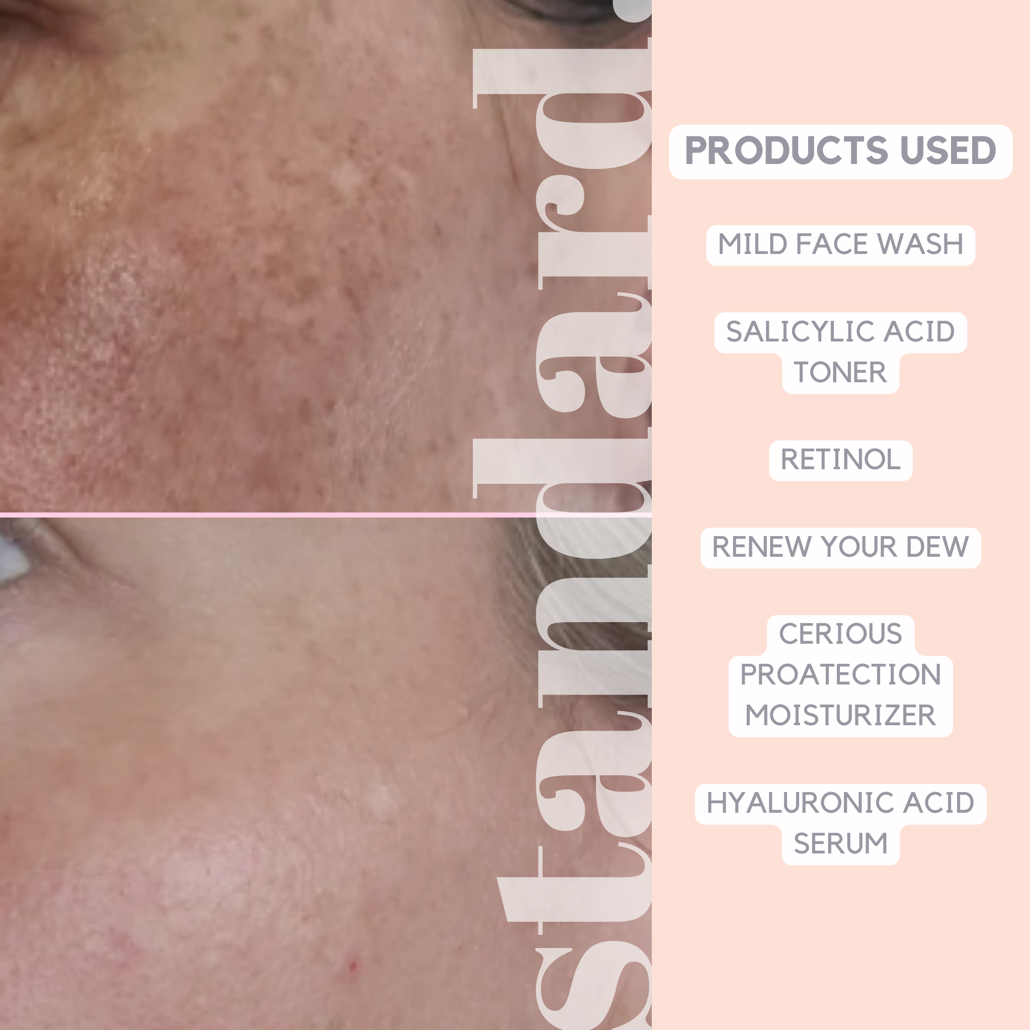 Retinol 1,5% (Vitamin A) Serum with Niacinamide & Hyaluronic Acid - 30ml